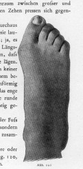 Fußdeformierung